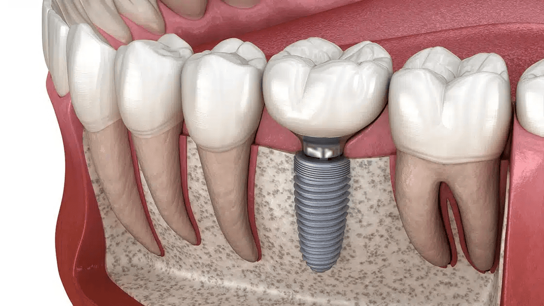 Implants at Central Washington Dental Care in Ellensburg WA