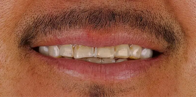 Dental Treatment - Before - Tri City Dental Care